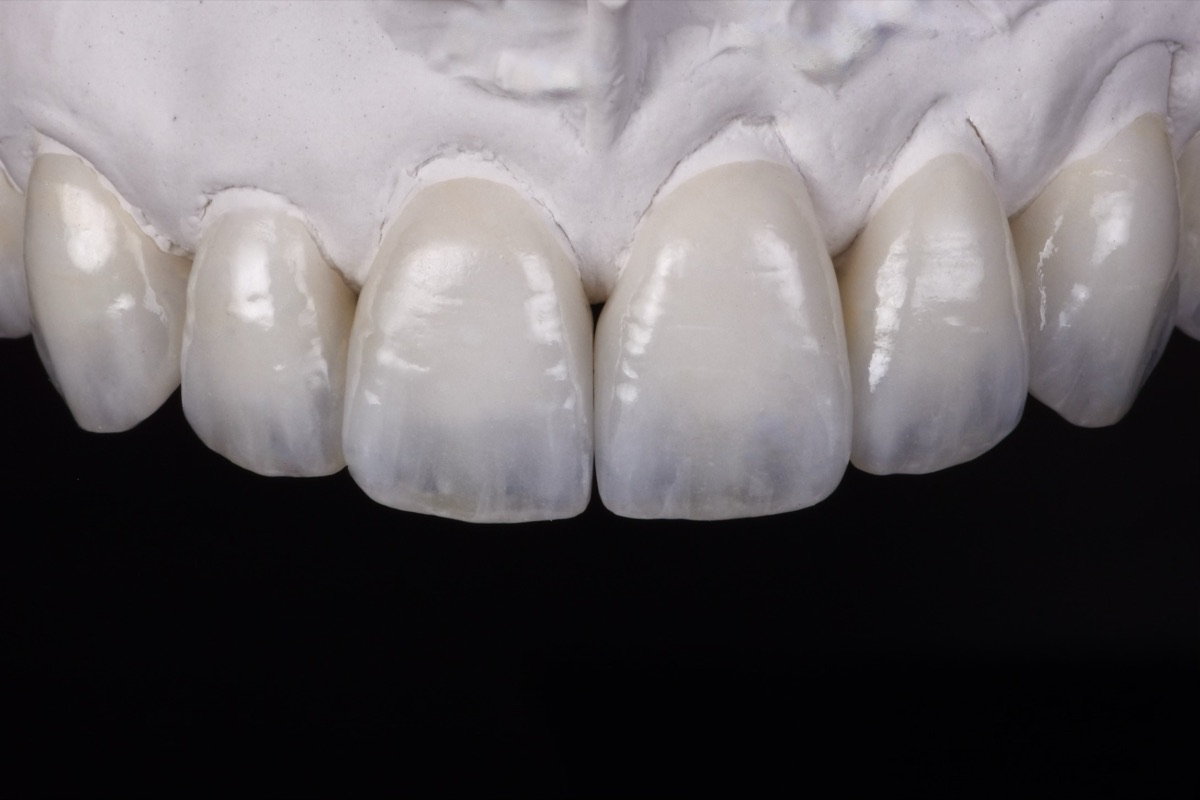 Hand-layered veneers showing natural translucency