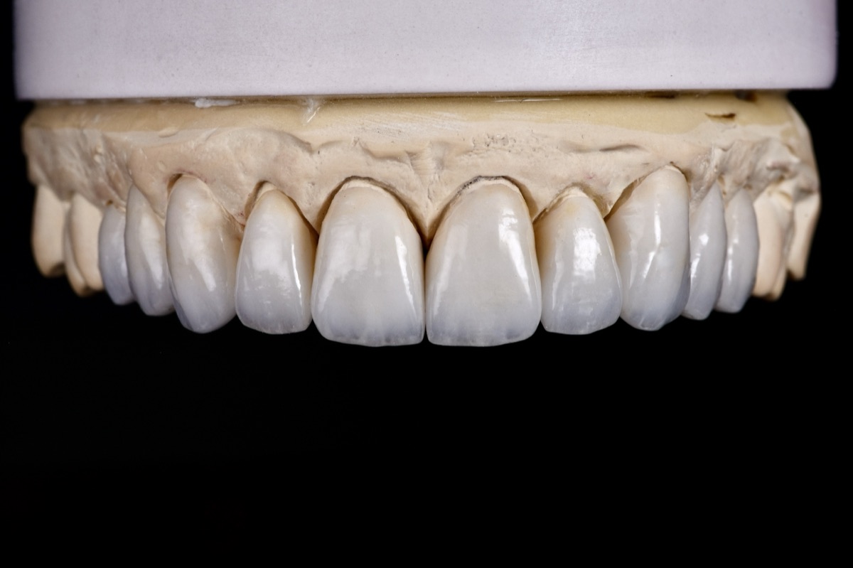 A full arch of finished veneers